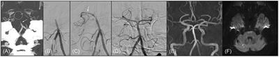 Endovascular and Clinical Outcomes of Vertebrobasilar Intracranial Atherosclerosis-Related Large Vessel Occlusion